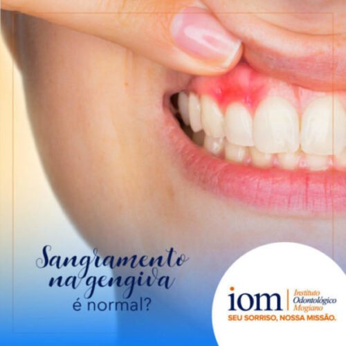 sangramento na gengiva