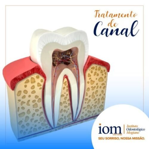 TRATAMENTO DE CANAL Tratamento de Canal