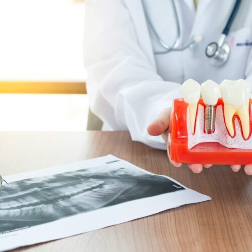 Implante Dentário