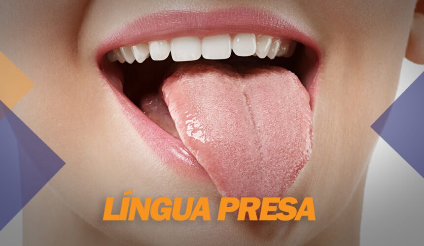 lingua-presa Língua Presa