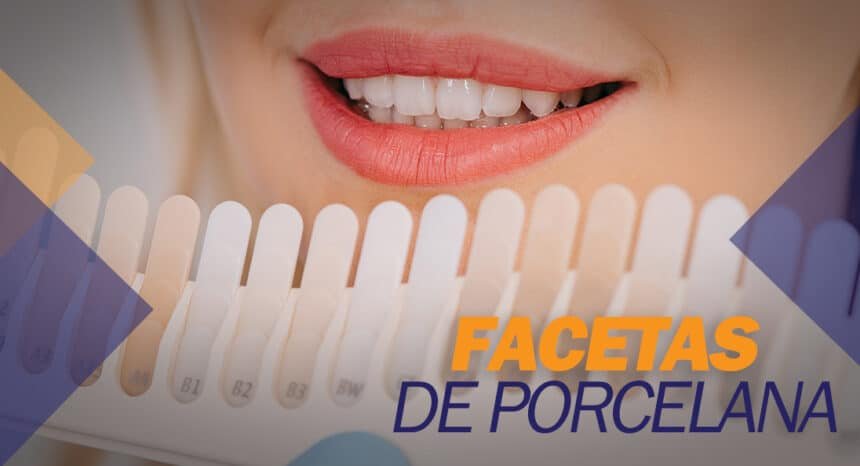 Facetas de Porcelana