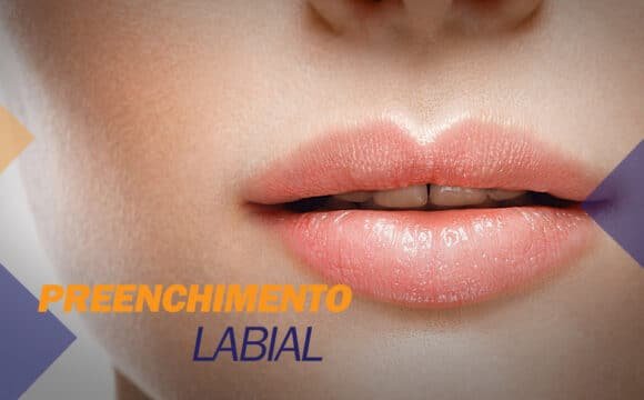 Preenchimento-labial Dica Dra. Analia sobre Preenchimento Labial