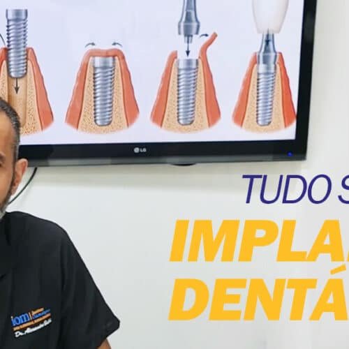 tudo-sobre-implante-dentario Tudo sobre Implante Dentário